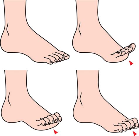 What to expect after hammertoe surgery | Nagy Footcare