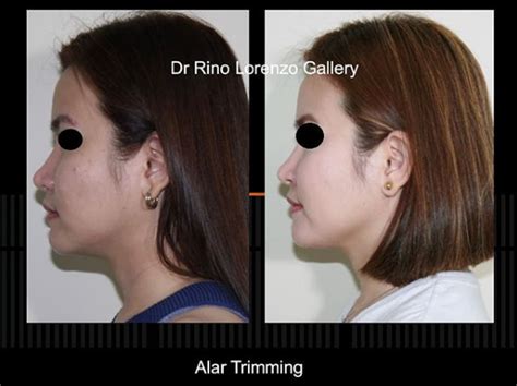 Enhanced Nasal Contour - Before and After Alar Trimming