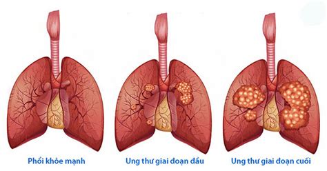cac phuong phap dieu tri ung thu phoi nam