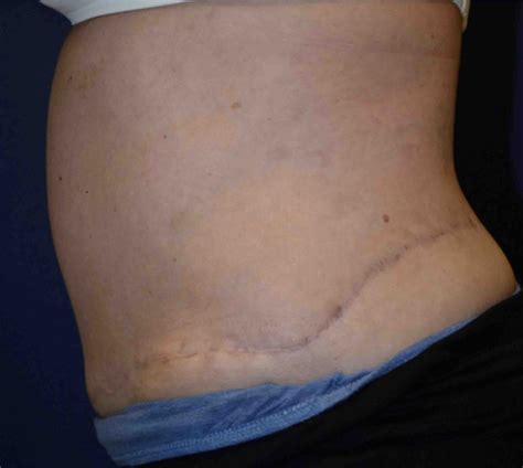 Panniculectomy: Procedure, Recovery, Pictures, and Cost