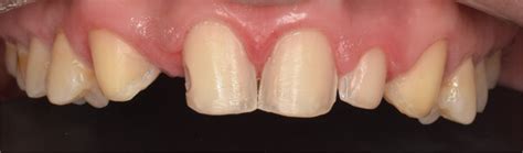 Frontal view of abutment tooth preparations. | Download Scientific Diagram