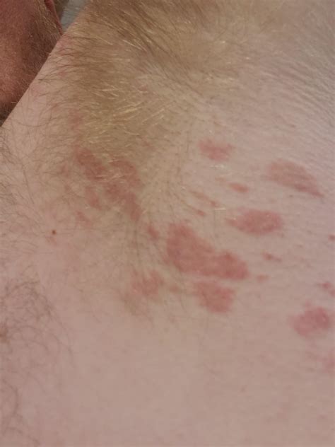 Rash in armpit, been using otc hydrocortisone cream. It itches like