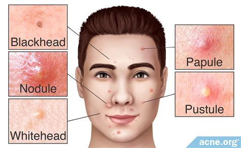 blackhead acneorg