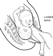 multiple pregnancy   antenatal complications obgyn key