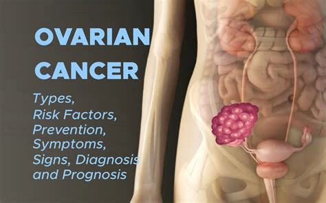 Ovarian Cancer: Types, Risk Factors, Prevention, Symptoms, Signs ...