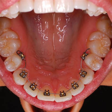 bracesinvisalign   adult lipstick alley