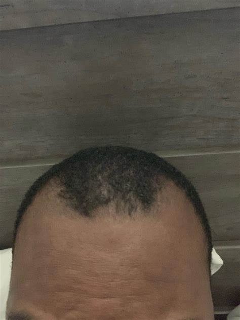 new laser therapies will soon stop hair thinning at hairline male 30