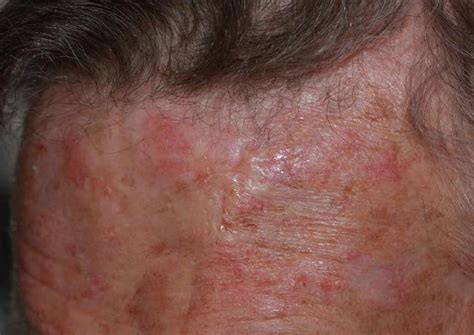 Basal Cell Carcinoma Stages Pictures at Gayla Wilson blog