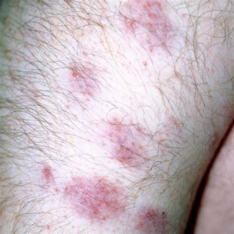 sarcoidosis rashes - pictures, photos