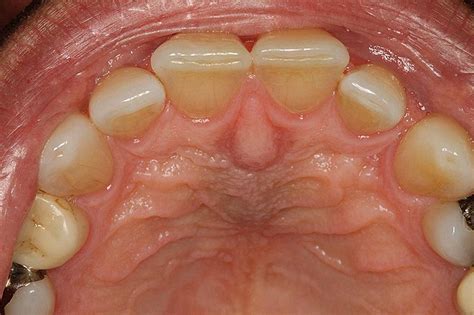 incisive papilla swollen  symptoms  treatment
