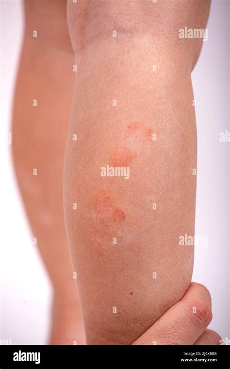 atopic dermatitis on children's feet Stock Photo - Alamy