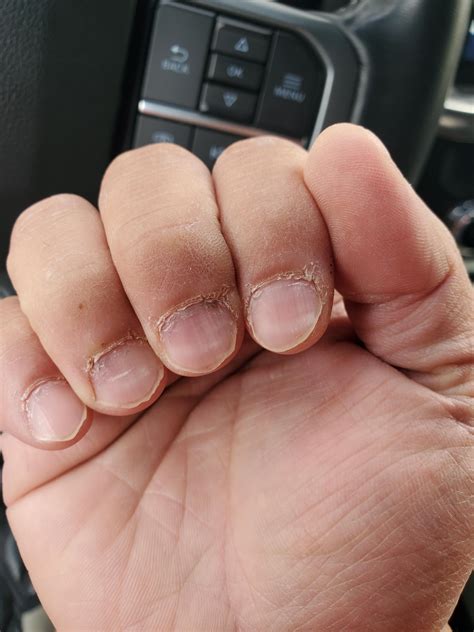 Are these mees lines on nails? Pics in comments : r/AskDocs