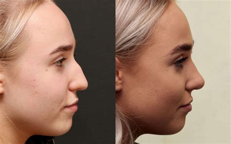 plastic surgery    nose jobs