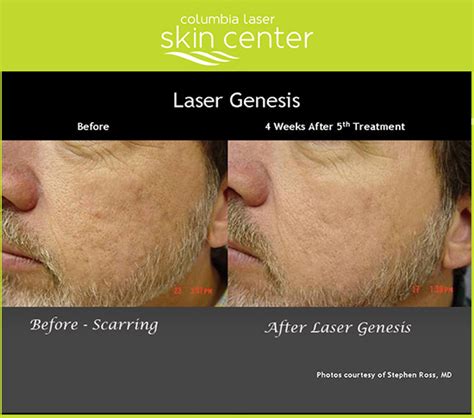 Columbia Laser Skin Center Laser Genesis - Before and After - Columbia ...