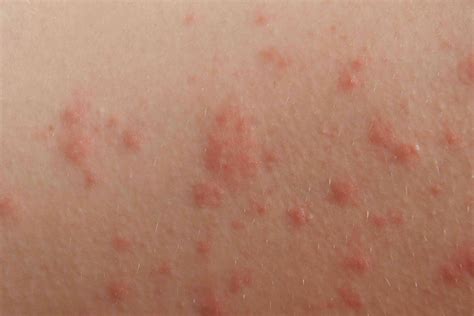 Simple Home Remedies for a Rash on Your Buttocks