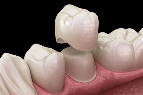 Dental Crown Aftercare: How to Protect Your New Tooth