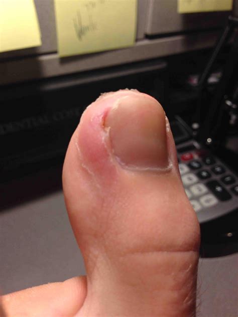 side of toe hurts so I went to the doctor and was diagnosed with