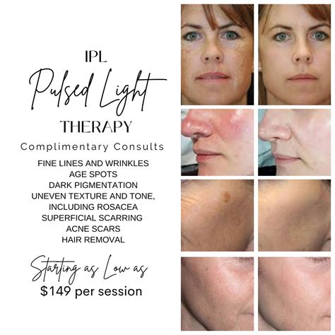 IPL Therapy – Florida Cosmetic Center