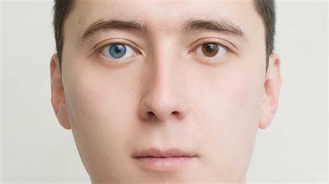 Heterochromia: Causes, Diagnosis and Treatment - accuspire