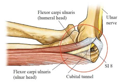 ulnar nerve entrapment   elbow acusport education