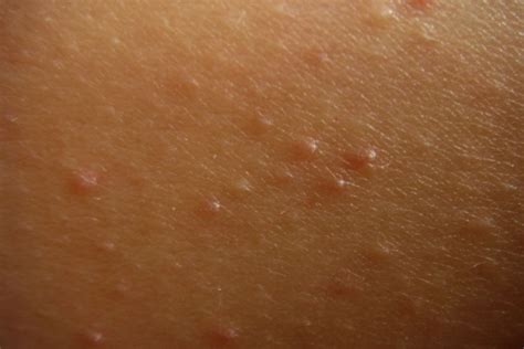 Raised Skin Bumps: Causes (With Pictures) and Treatment
