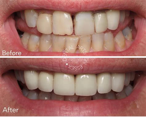 Before And After - Dental Arts on Essex