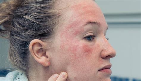 Eczema Face Causes