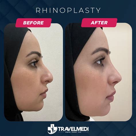 Nose Job in Turkey - Prices, Before - After 2024
