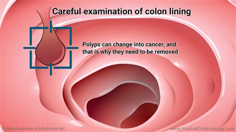 Slide Show - What happens during and after a colonoscopy?