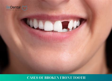 broken front tooth cases  ways  fix