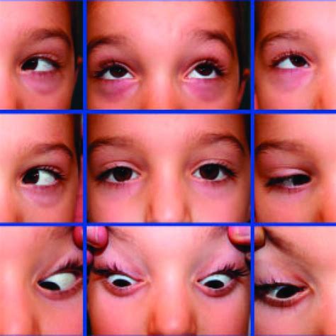 positions  gaze note  restricted elevation    eye