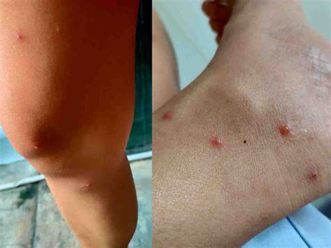 bentol merah gatal digigit kutu kucing travel diary  lenny lim