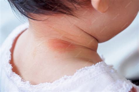 Alergia No Pescoço Do Bebê O Que Passar