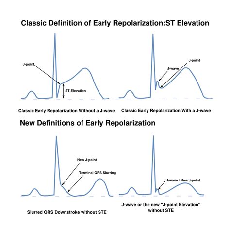 early repolarization ecgpedia