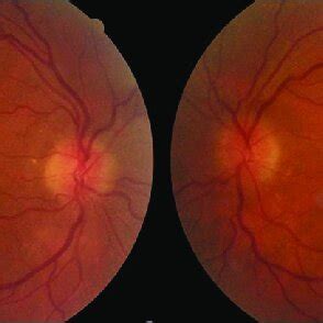 Fundus photograph showing optic disc edema | Download Scientific Diagram