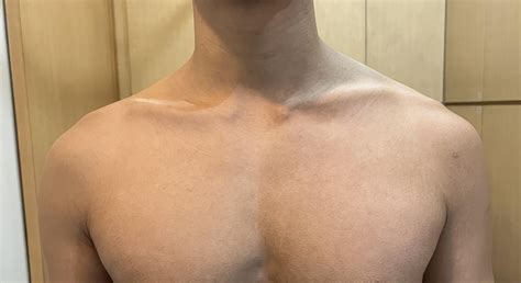Uneven back/traps and chronic neck tightness : r/flexibility