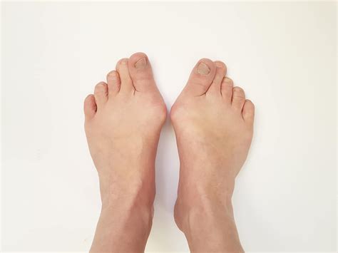 Bunions 101: Causes, Symptoms, and Effective Management Strategies