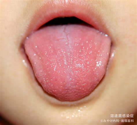 溶連菌感染症の口と舌の症状 ｜ 写真で見る「子どもの病気」 - みやけ内科・循環器科【総合内科のアプローチ】