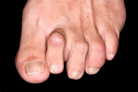 hammer toes