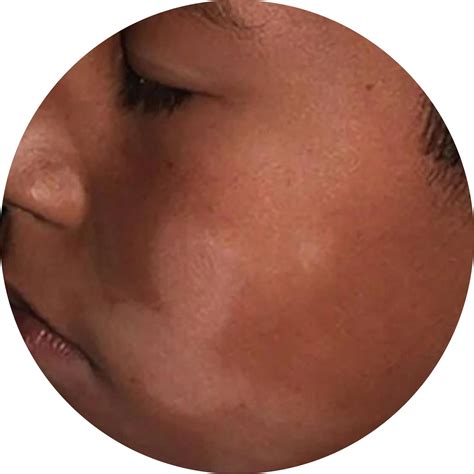 Why Do I Have White Patches On My Cheeks - Infoupdate.org