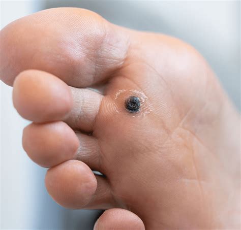 Is This Diabetes Rash on My Foot a Warning Sign