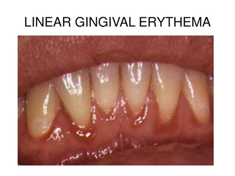 Linear Gingival Erythema