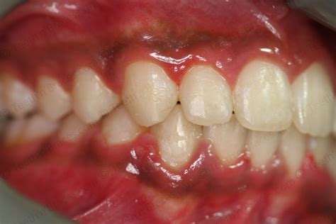 Case 22: Overlapping incisors | Teeth N Braces