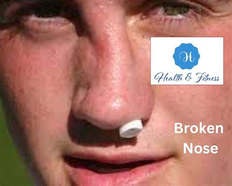 broken nose unveiling  hidden challenges  solutions