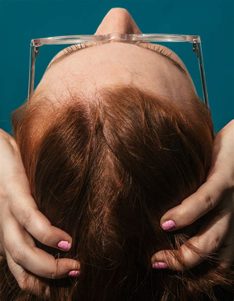 Most Common Vitamin Deficiency For Hair Loss - Infoupdate.org