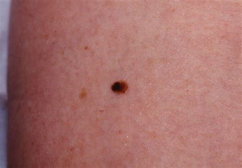 Melanoma pictures stage 4 | Symptoms and pictures