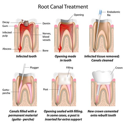 My tooth is dead! | Hoyt Dental | Murrieta & Temecula Dentist ...