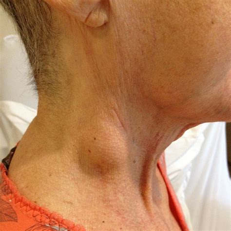 Nodulo No Pescoço Que Doi - Nódulo no Pescoço: Afinal, o que Pode Ser?