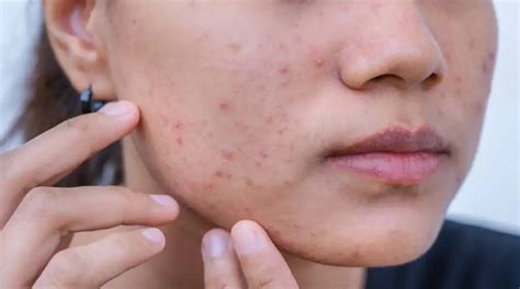 acne mapping understanding breakouts   facial areas