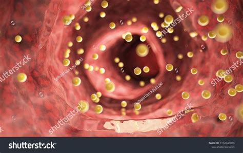 3d rendered medically accurate illustration of colon inflammation ...